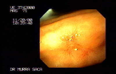 Cicatriz de Úlcera Gástrica.