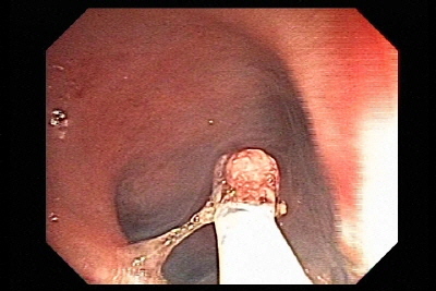 Polipectomia endoscopica