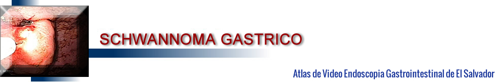 Schwannoma Gástrico Atlas de Videoendoscopia Gastrointestinal de El Salvador