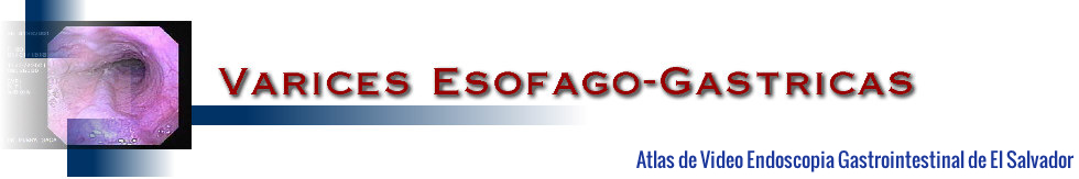 varices Esofago