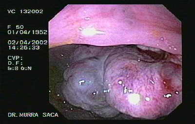 Metástasis de Carcinoma Renal. a colon