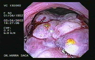 Metástasis de Carcinoma Renal. a colon