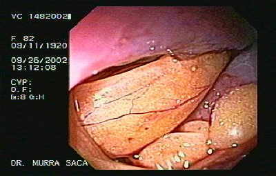 Perforación del colon sigmoides.