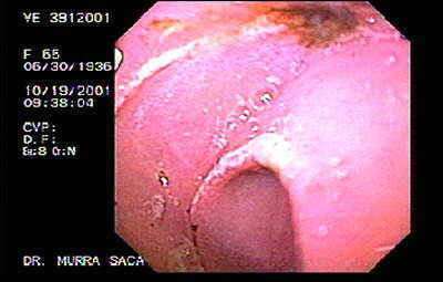 Ulcera Gástrica