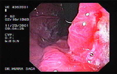 Endoscopia de Adenocarcinoma ulcerado de la incisura angularis