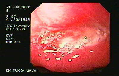 Úlcera Gástrica y Cirrosis Hepática
