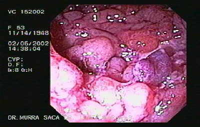 Moderada a severos signos de colitis ulcerativa inespecífica, se observan granularidad, friabilidad, exudado, espontáneo sangrado y áreas grandes de ulceraciones. 