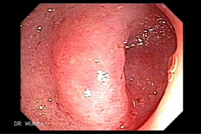 Endoscopic View of Ulcerative Colitis with Pseudopolyps