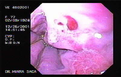 escleroterapia Várices esófago