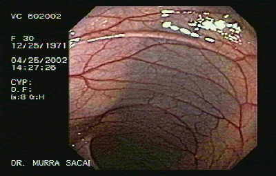 El agujero de la apéndice es observado en el ciego.