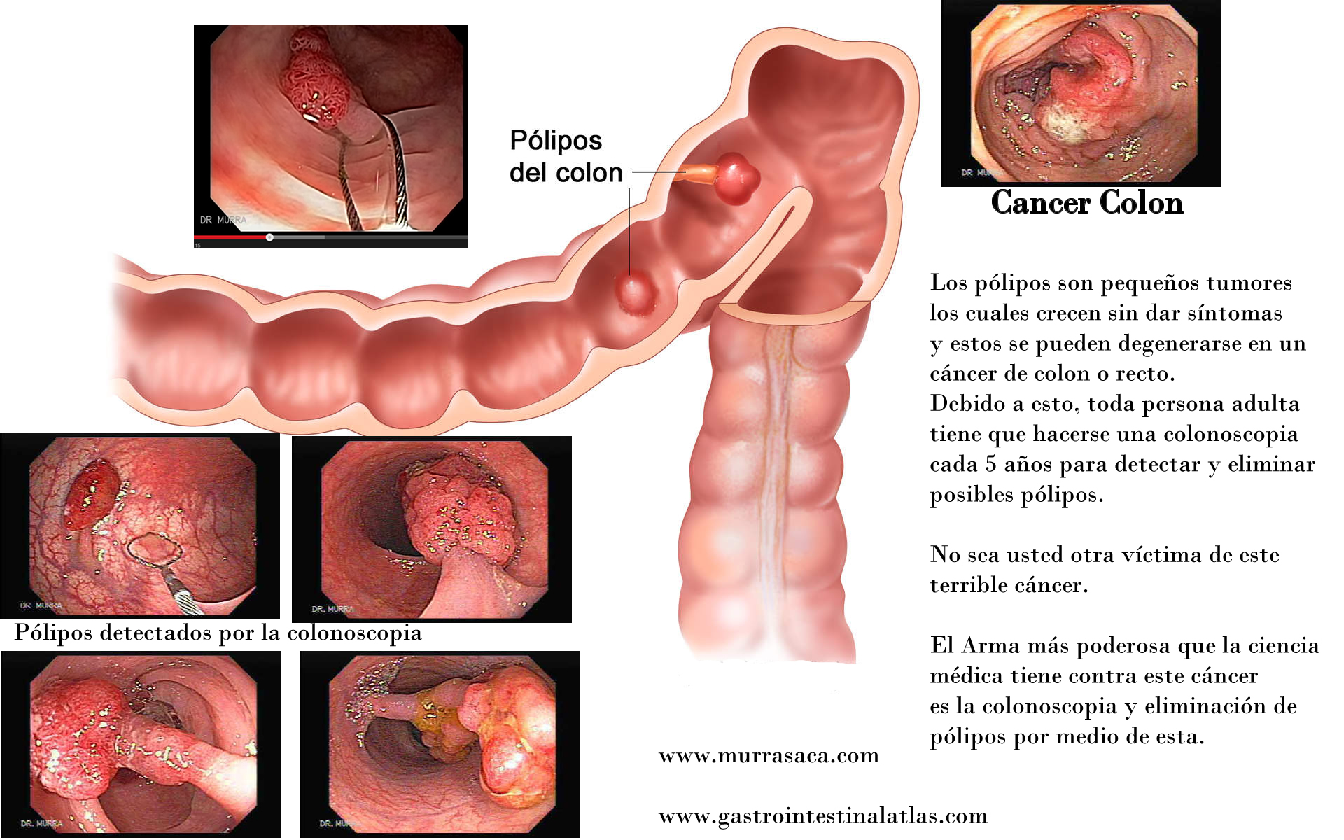 Cancer colon sintomas, Traducere 