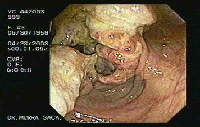 Endoscopia San Miguel
