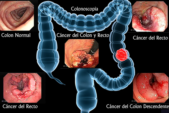 Cáncer Colorrectal