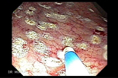 Endoscopic view of Post-irradiation proctitis