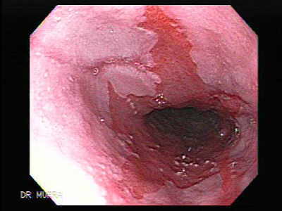 Esófago de Barret II - El Atlas Gastrointestinal - gastrointestinalatlas.com