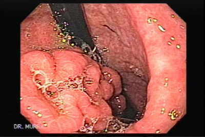 Metastatic colon adenocarcinoma of the stomach