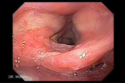 Carcinoma Epidermoid of the Larynx