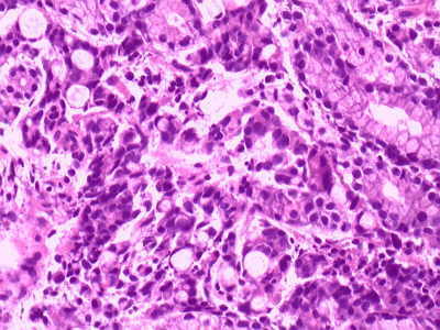 cancer gastric biopsial