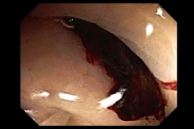 Diverticulitis debido a Hueso de Pescado