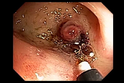 Diverticulitis debido a Hueso de Pescado