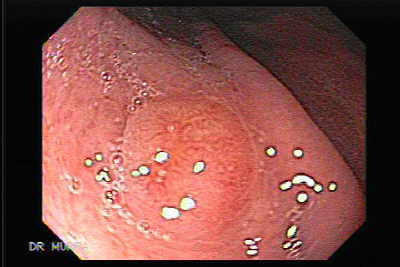 Gastric Carcinoid Tumor