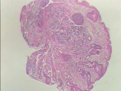 Gastric Carcinoid Tumor