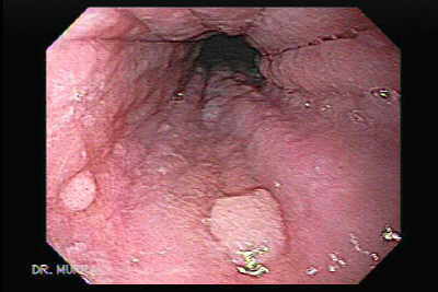 Glycogenic Acanthosis of the Esophagus.