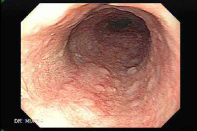 Glycogenic acanthosis of the esophagus