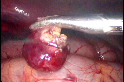 Laparoscopy of Liver Cancer