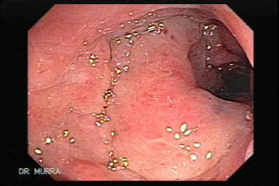 Cervix Carcinoma that Infiltrated the Rectum