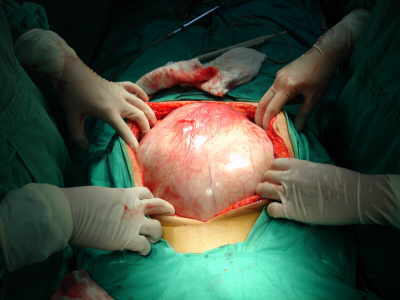 Giant Ovarian Serous Cystadenoma