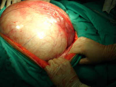 Giant Ovarian Serous Cystadenoma