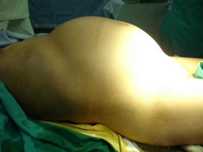 Giant Ovarian Serous Cystadenoma