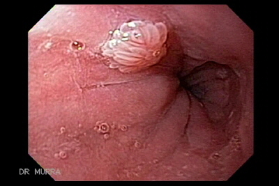 esophageal papilloma hpv
