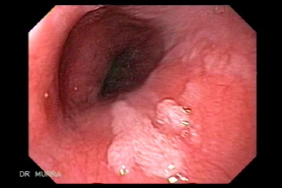papilloma in the esophagus)