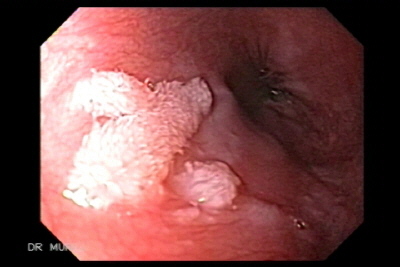 Squamous cell papilloma esophagus