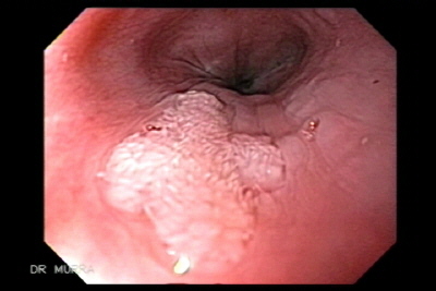 define esophageal papilloma