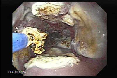 Argon plasma coagulation of Barrett's esophagus.