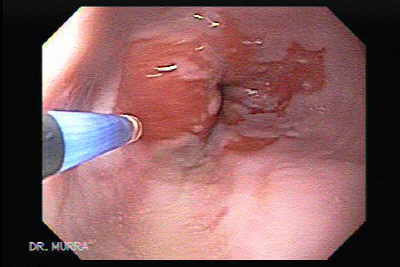 Endoscopic Ablation of Barrett's esophagus with argon plasma coagulator.