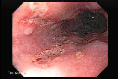 Tetracyclines are the most common antibiotics to induce esophagitis, particularly doxycycline.