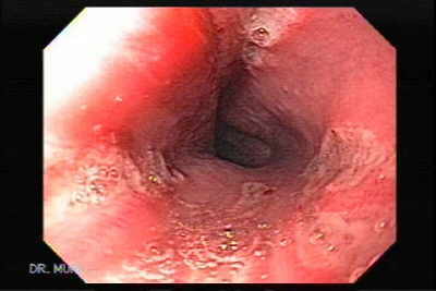 This 43 year-old male, presented with dysphagia,