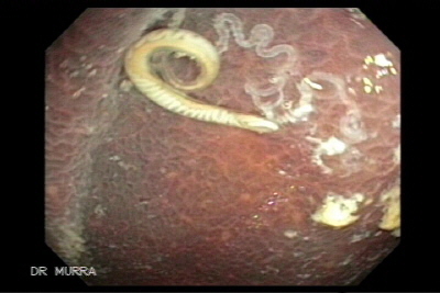 Melanosis Coli and Trichuris Trichuris whipworm
