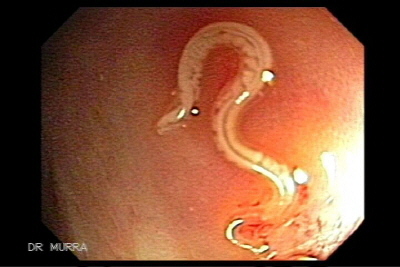 Colonoscopy of a whipworm