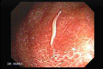 Melanosis Coli and Schistosoma Mansoni