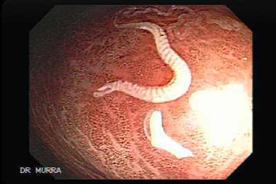 Melanosis Coli and Schistosoma Mansoni