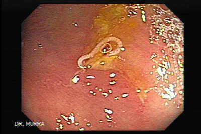Schistosoma Mansoni in the Cecum