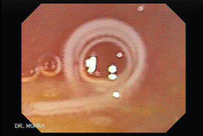 Schistosoma Mansoni in the Cecum
