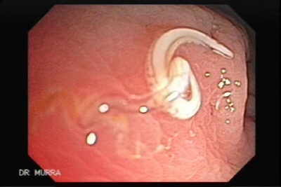 Endoscopy Image of Trichuris Trichuris (whipworm).