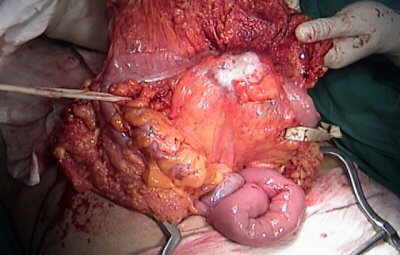Metastases of Renal Carcinoma to Ascending Colon