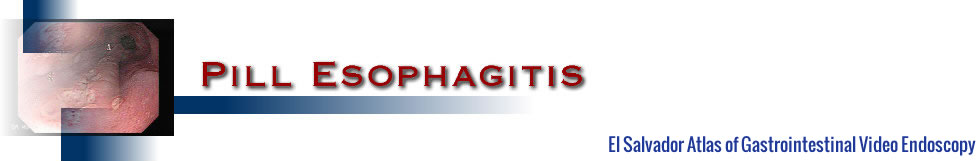 Pill Esophagitis